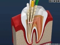 牙齿痛可以通过根管治疗解决吗？